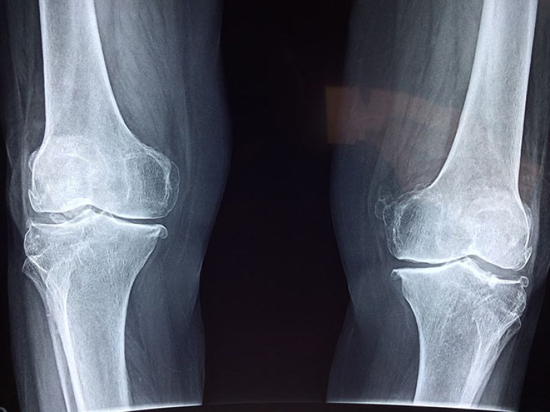 Rarefazione del tessuto osseo conosciuta come Osteoporosi